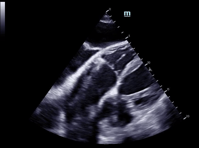Subcostal ascites vs pericardial effusion