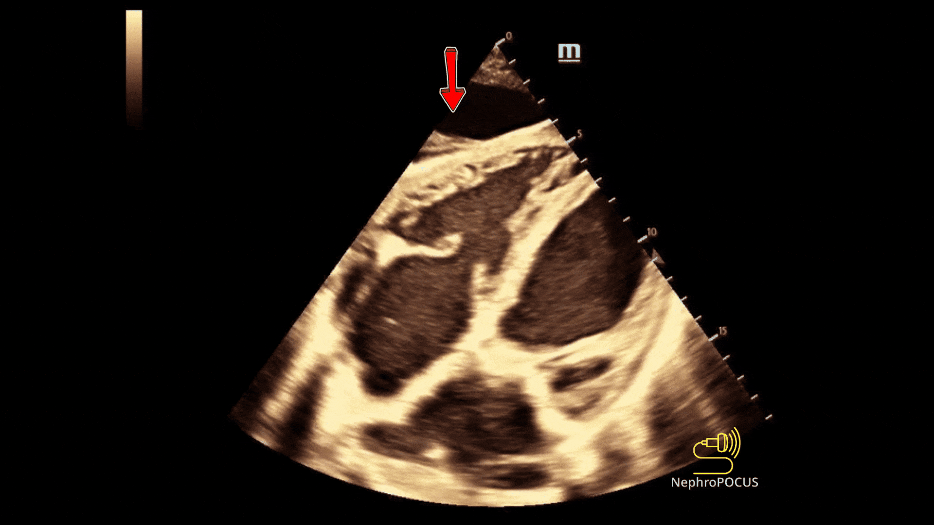 Subcostal ascites vs pericardial effusion