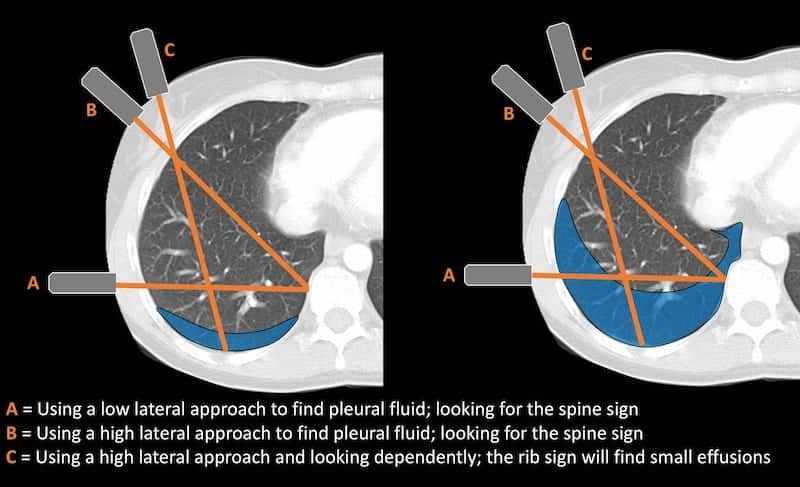 Spine sign