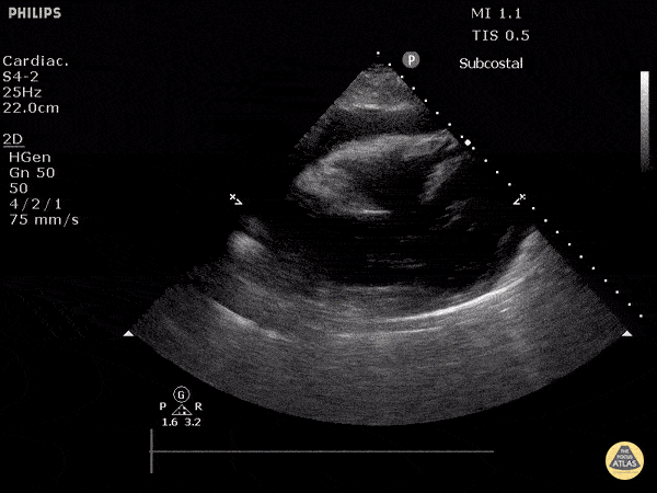 Pericardial Disease - Cardiac Tamponade - Subxiphoid View