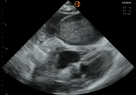 Subcostal ascites vs pericardial effusion
