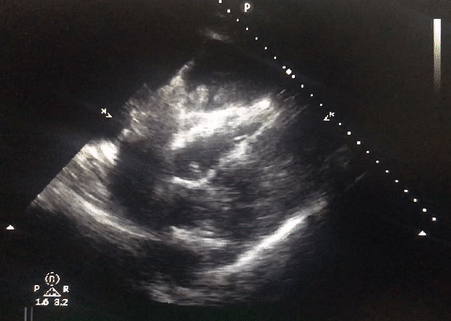 Subcostal ascites vs pericardial effusion